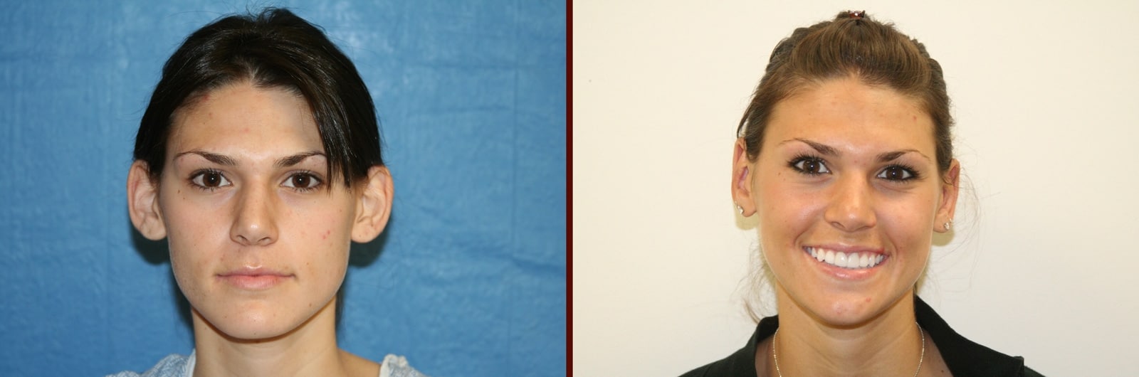 Ear Surgery Orange County CA 1 Image