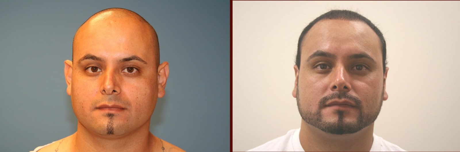 Ear Surgery Orange County CA 2 Image