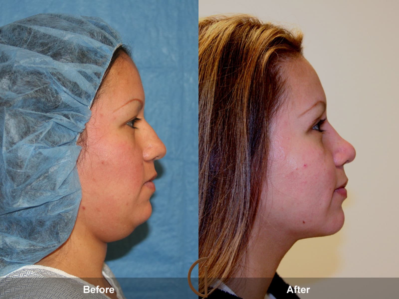 Rhinoplasty Nose Surgery Orange County CA 1 Image