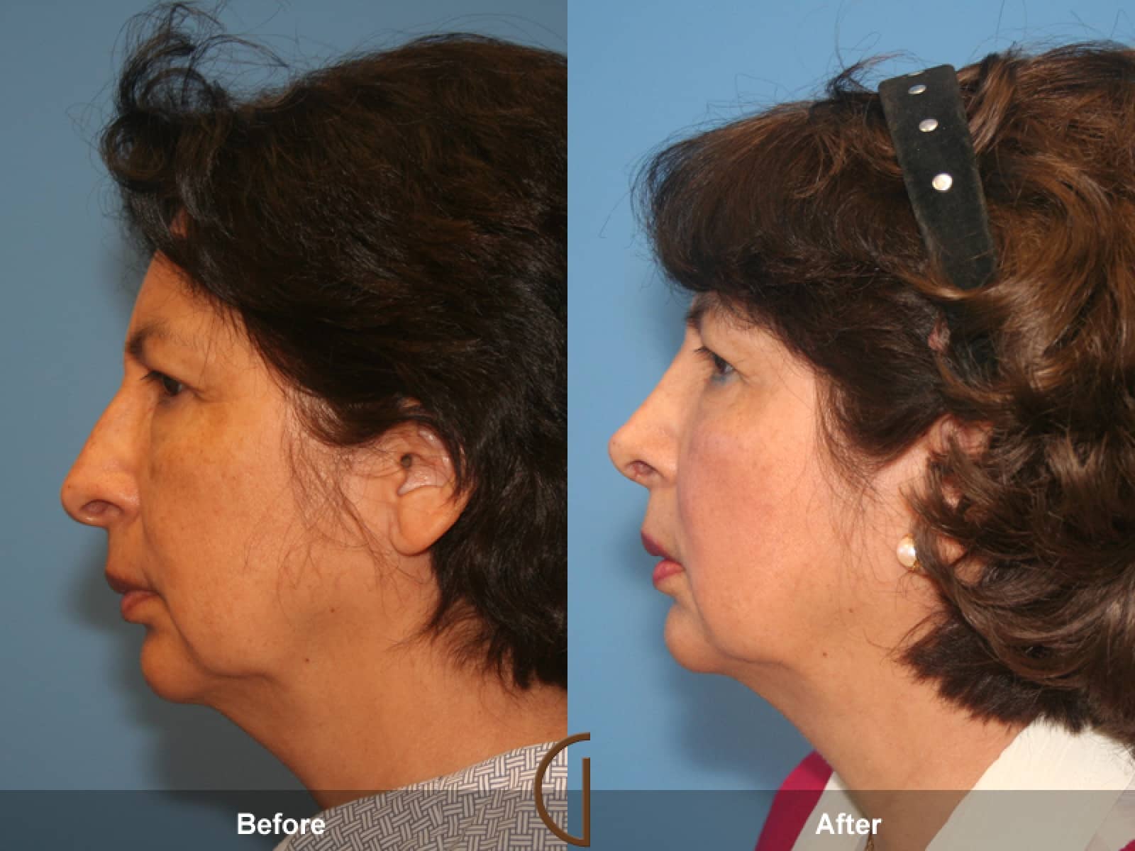 Rhinoplasty Nose Surgery La Cañada Flintridge CA 28 Image
