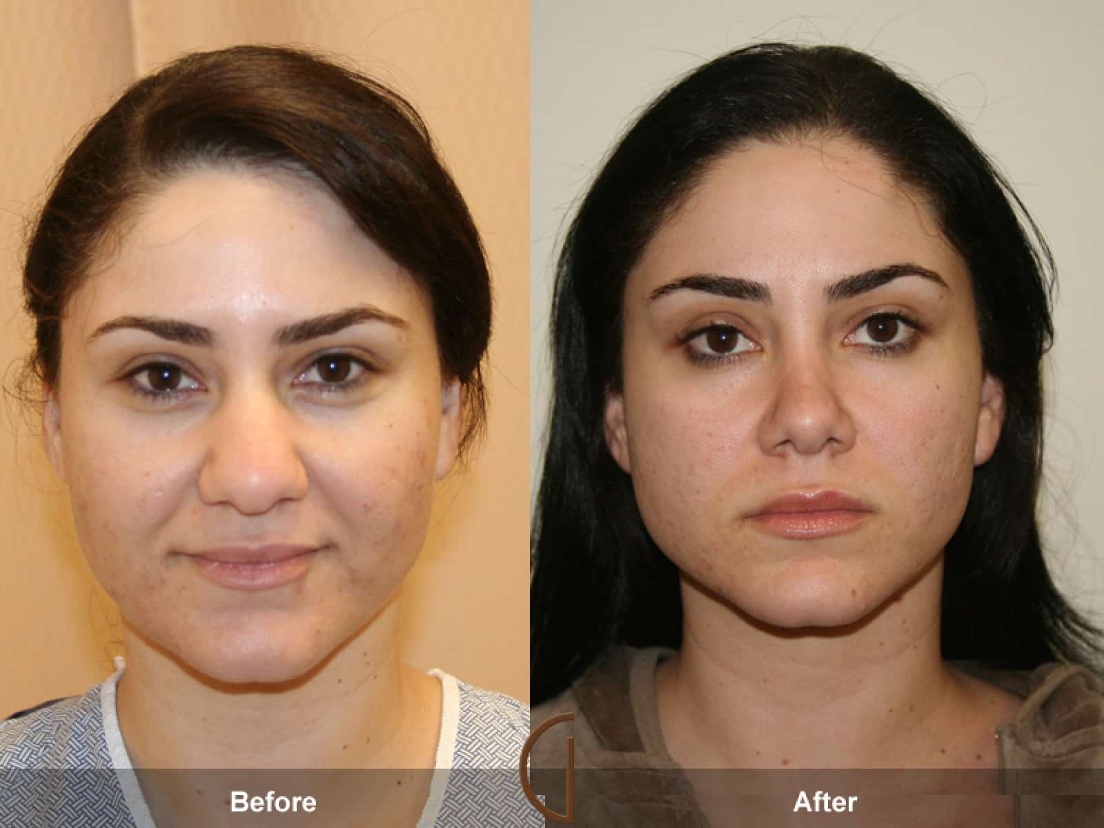 Rhinoplasty Nose Surgery Rolling Hills Estates CA 3 Image