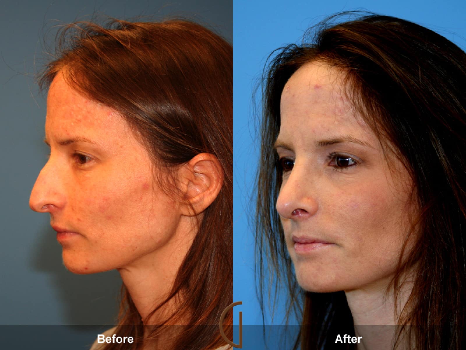Rhinoplasty Nose Surgery Topanga CA 44 Image