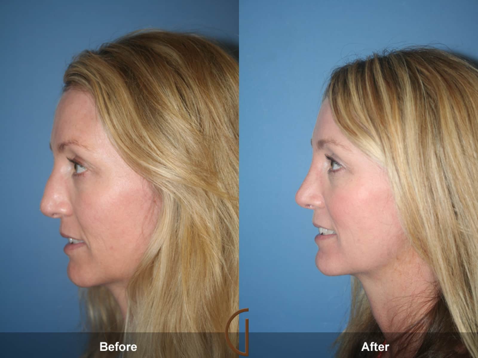 Rhinoplasty Nose Surgery Stevenson Ranch CA 45 Image