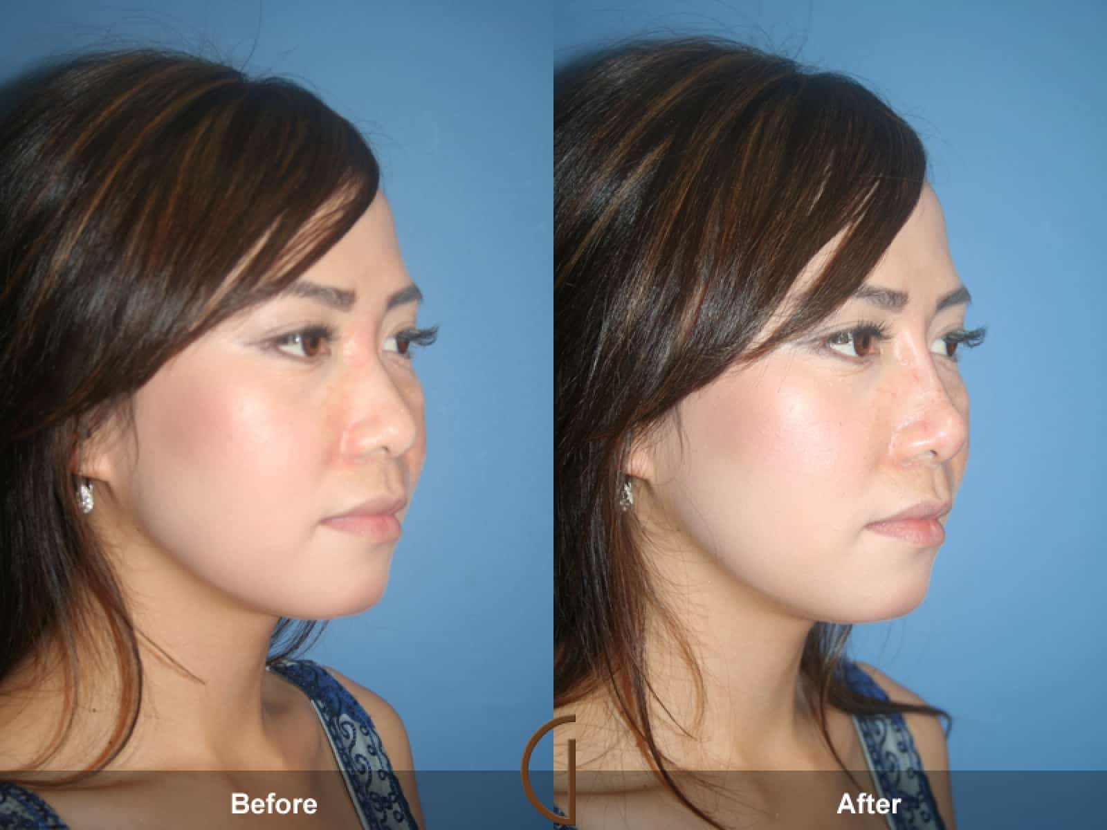 Rhinoplasty Nose Surgery Bradbury CA 46 Image