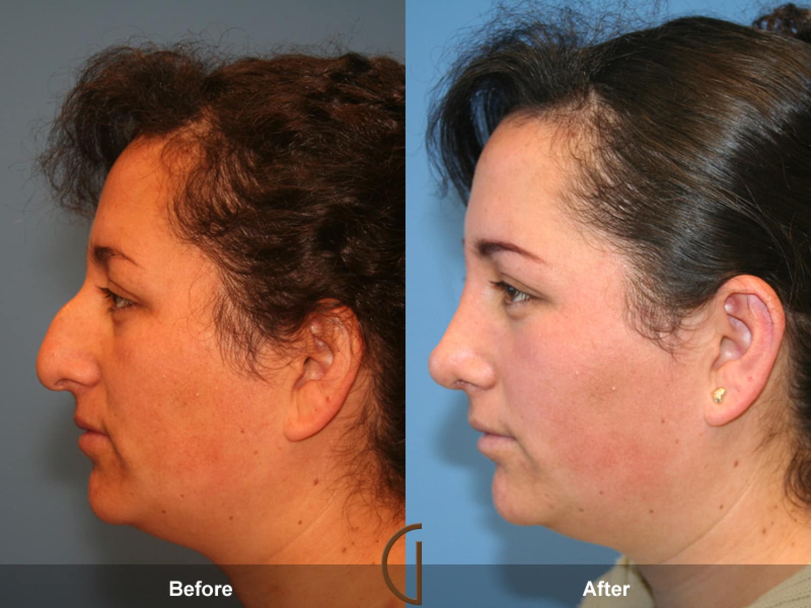 Rhinoplasty Nose Surgery Marina del Rey CA 6 Image