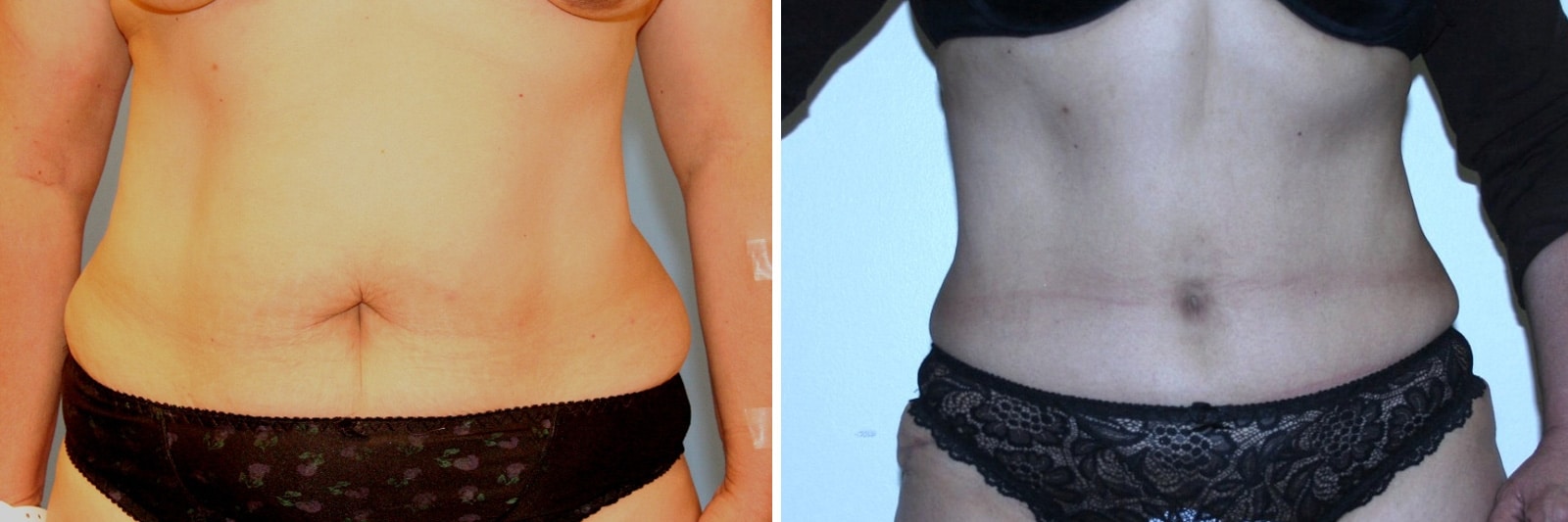 Diet After Plastic Surgery Image