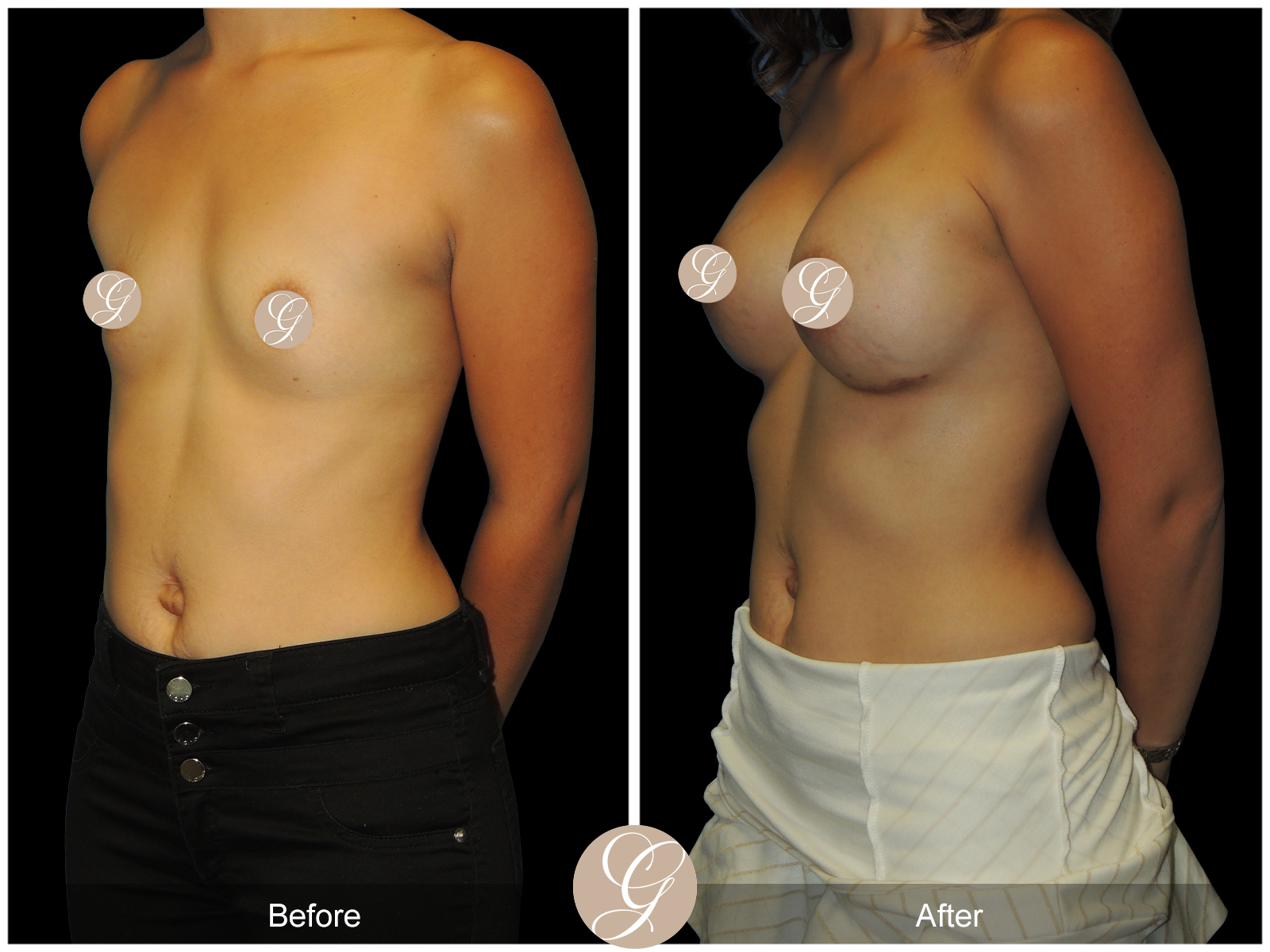 Breast Augmentation PT15 Image