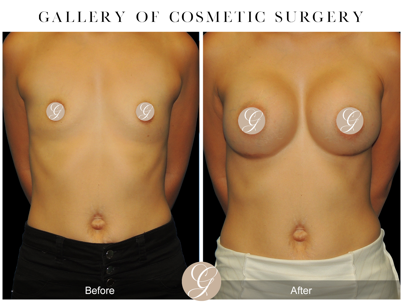 Breast Augmentation PT15 Image