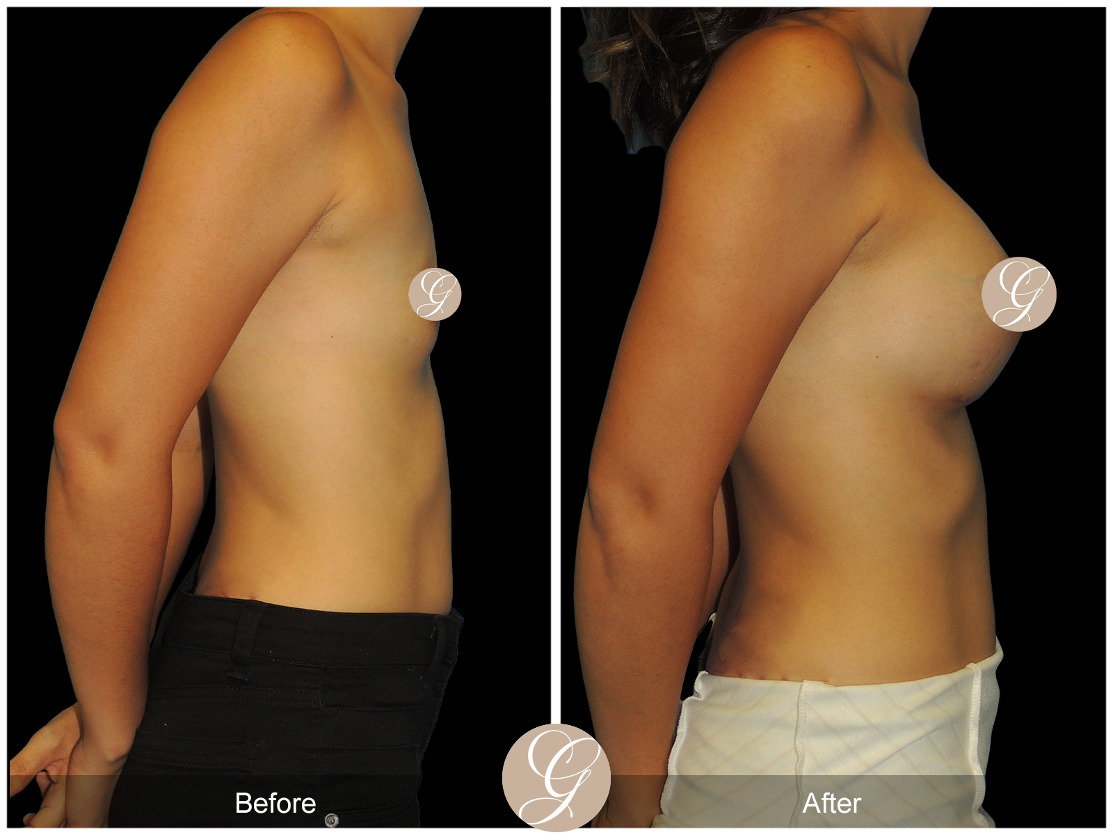 Breast Augmentation PT15 Image