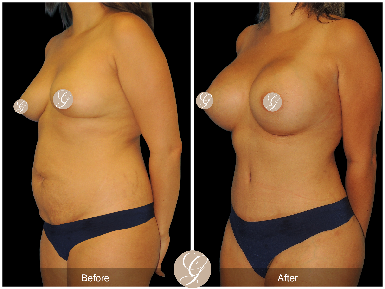Tummy Tuck PT3 Image