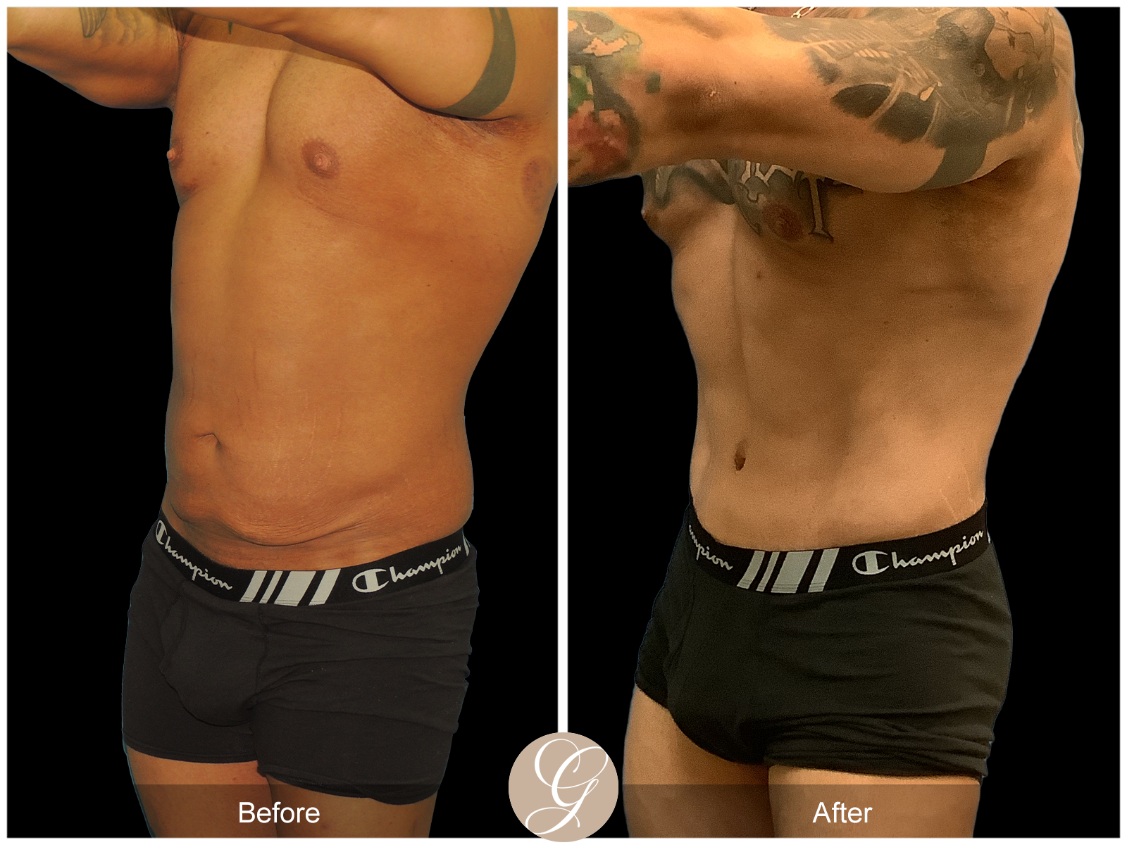 VASER High Definition Surgery for Men PT5 Image