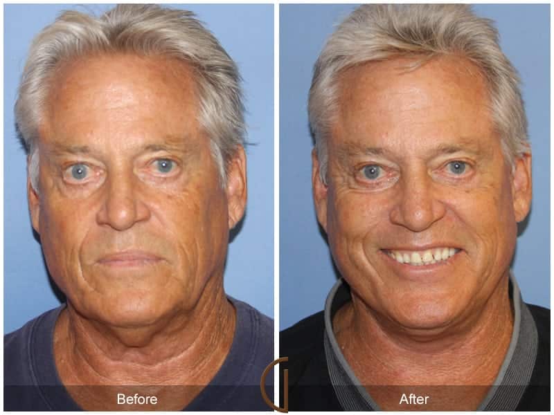 Male Facelift Newport Beach Image