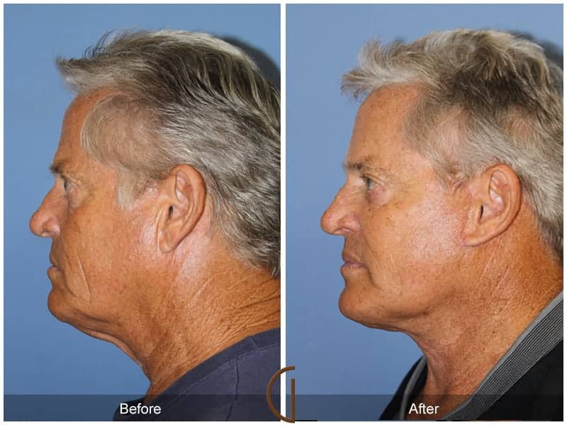 Male Facelift Newport Beach Image