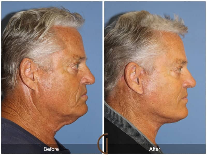 Male Facelift Newport Beach Image
