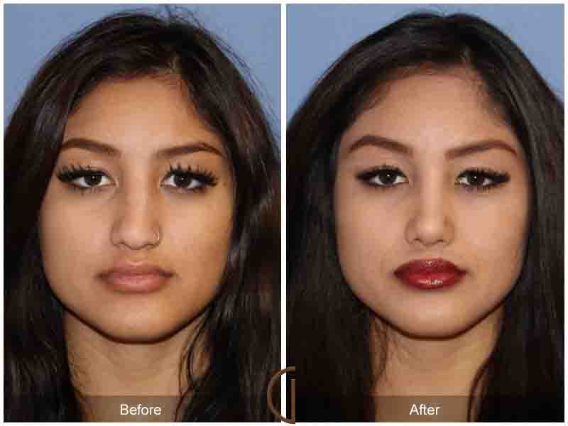 Ethnic Rhinoplasty Newport Beach 82 Image