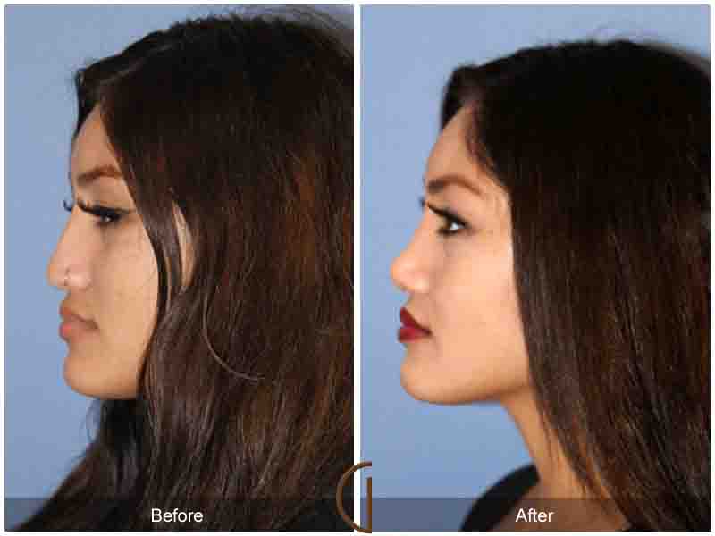 Ethnic Rhinoplasty Newport Beach 82 Image