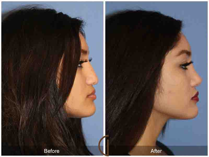 Ethnic Rhinoplasty Newport Beach 82 Image
