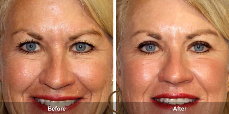 Eyelid Surgery Newport Beach 64 Image
