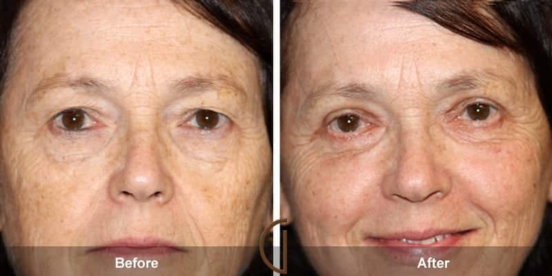 Eyelid Surgery Newport Beach 61 Image