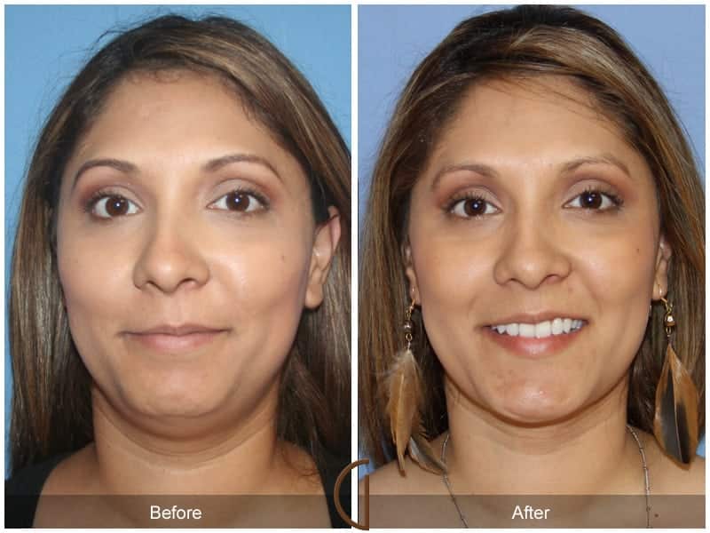 Chin Augmentation Orange County CA 117 Image