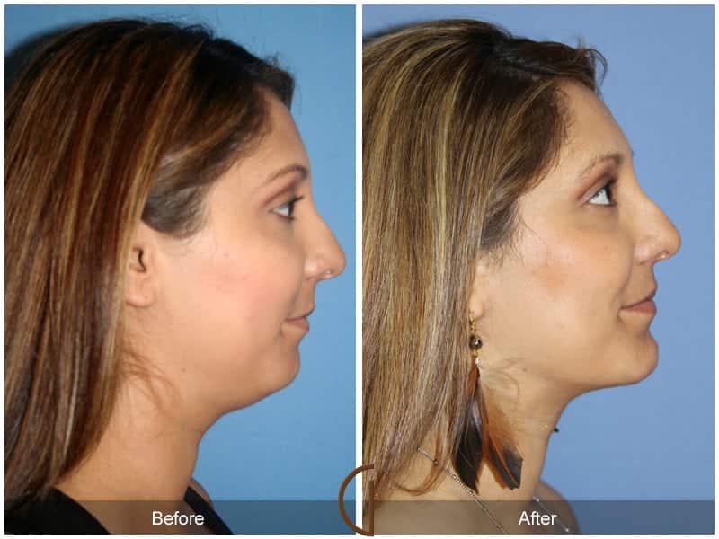 Chin Augmentation Orange County CA 117 Image