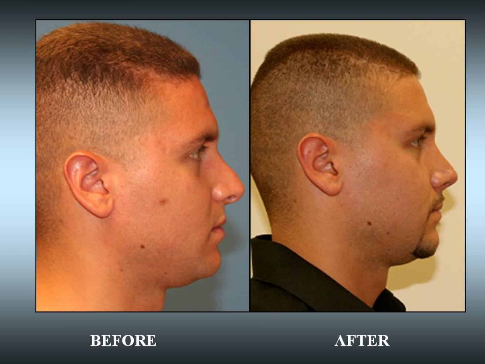 California Male Rhinoplasty Image