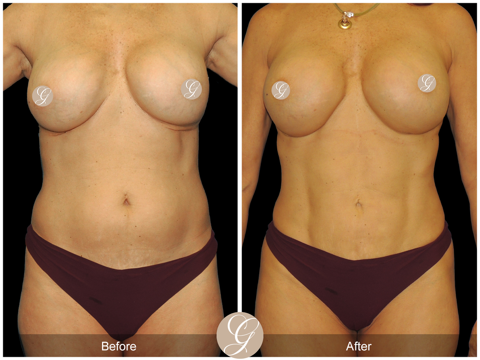 VASER 360 HIGH DEFINITION BODY SCULPTING PT9 Image