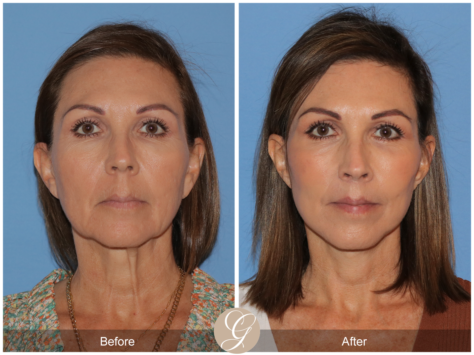 Preservation Facelift Case 13 Image