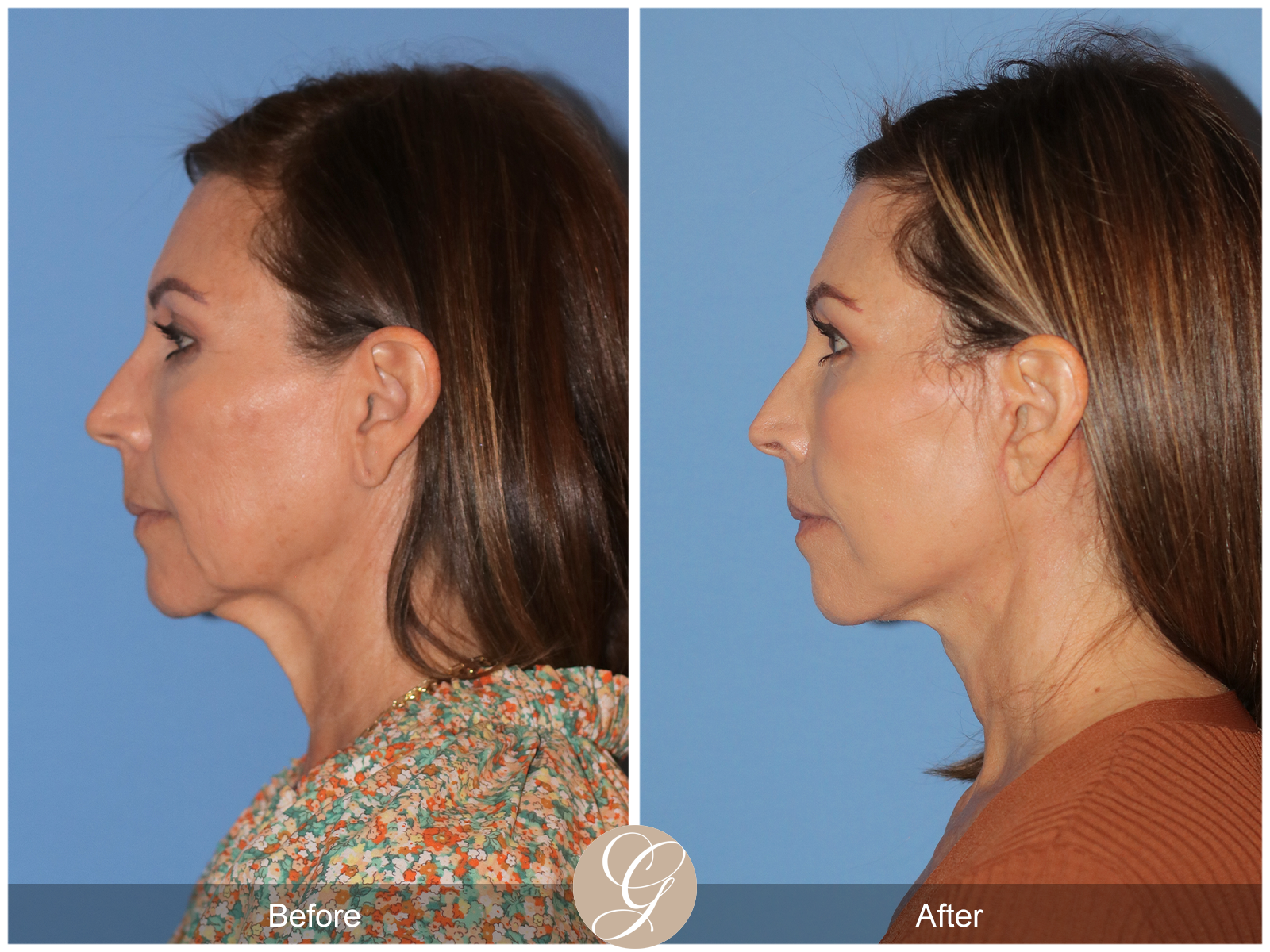 Preservation Facelift Case 13 Image