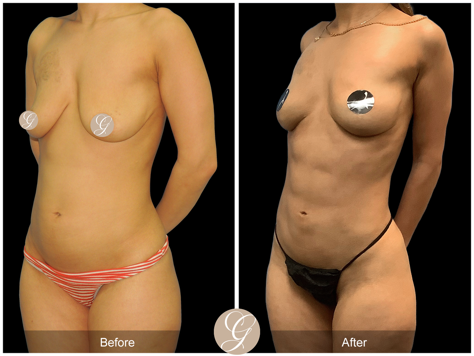 VASER 360 HIGH DEFINITION BODY SCULPTING PT10 Image