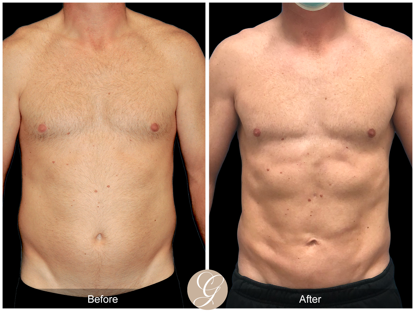 Gynecomastia PT3 Image