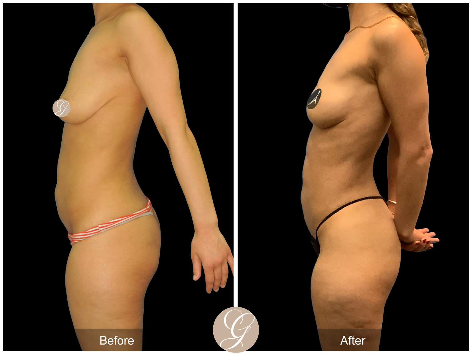 VASER 360 HIGH DEFINITION BODY SCULPTING PT10 Image