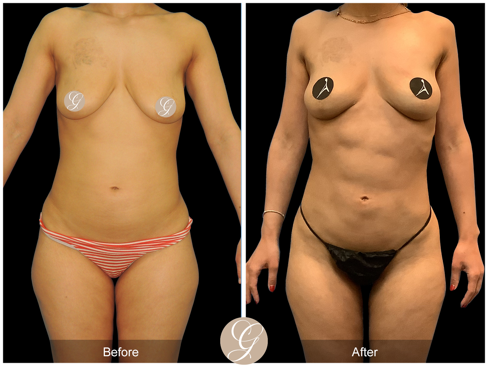 Best High Definition Body Contouring