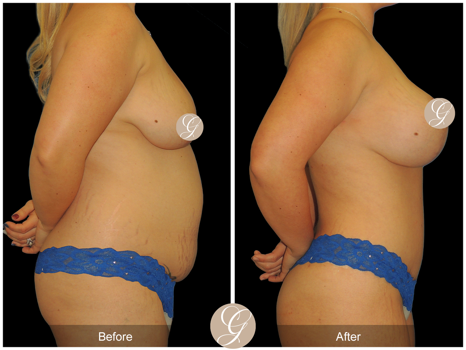 Mommy Makeover PT1 Image