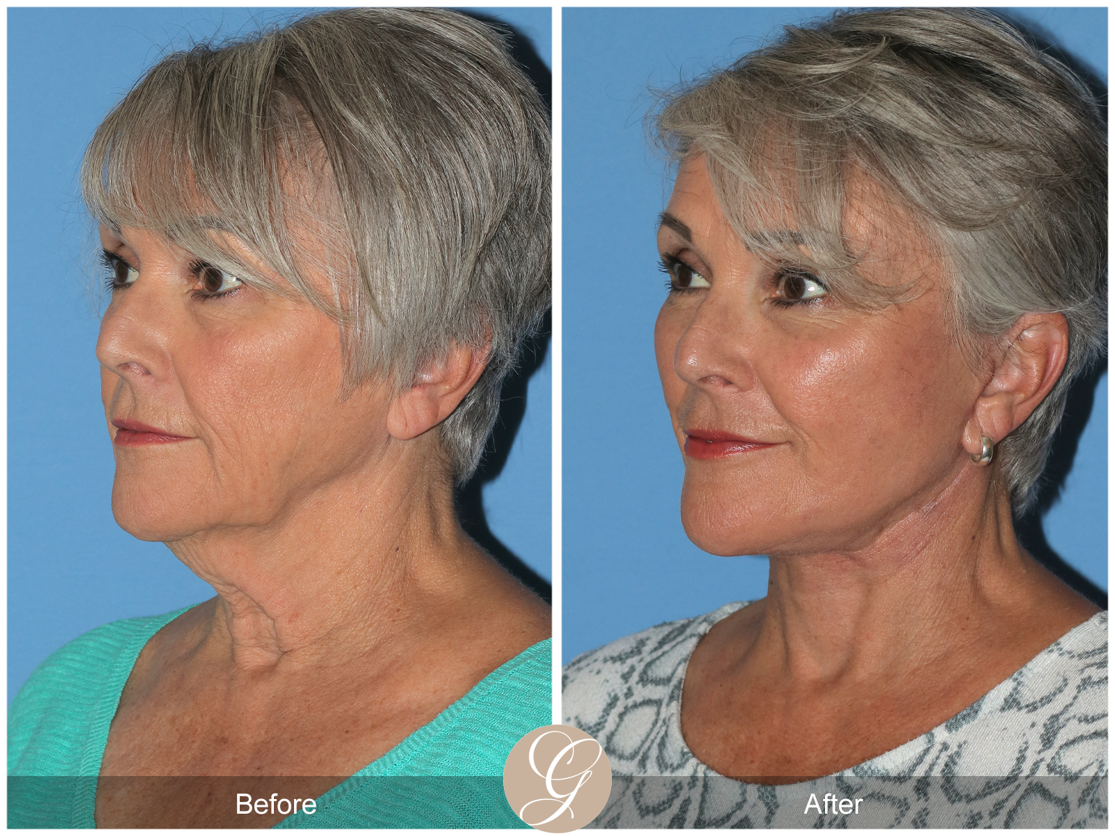 Preservation Facelift Case 8 Image