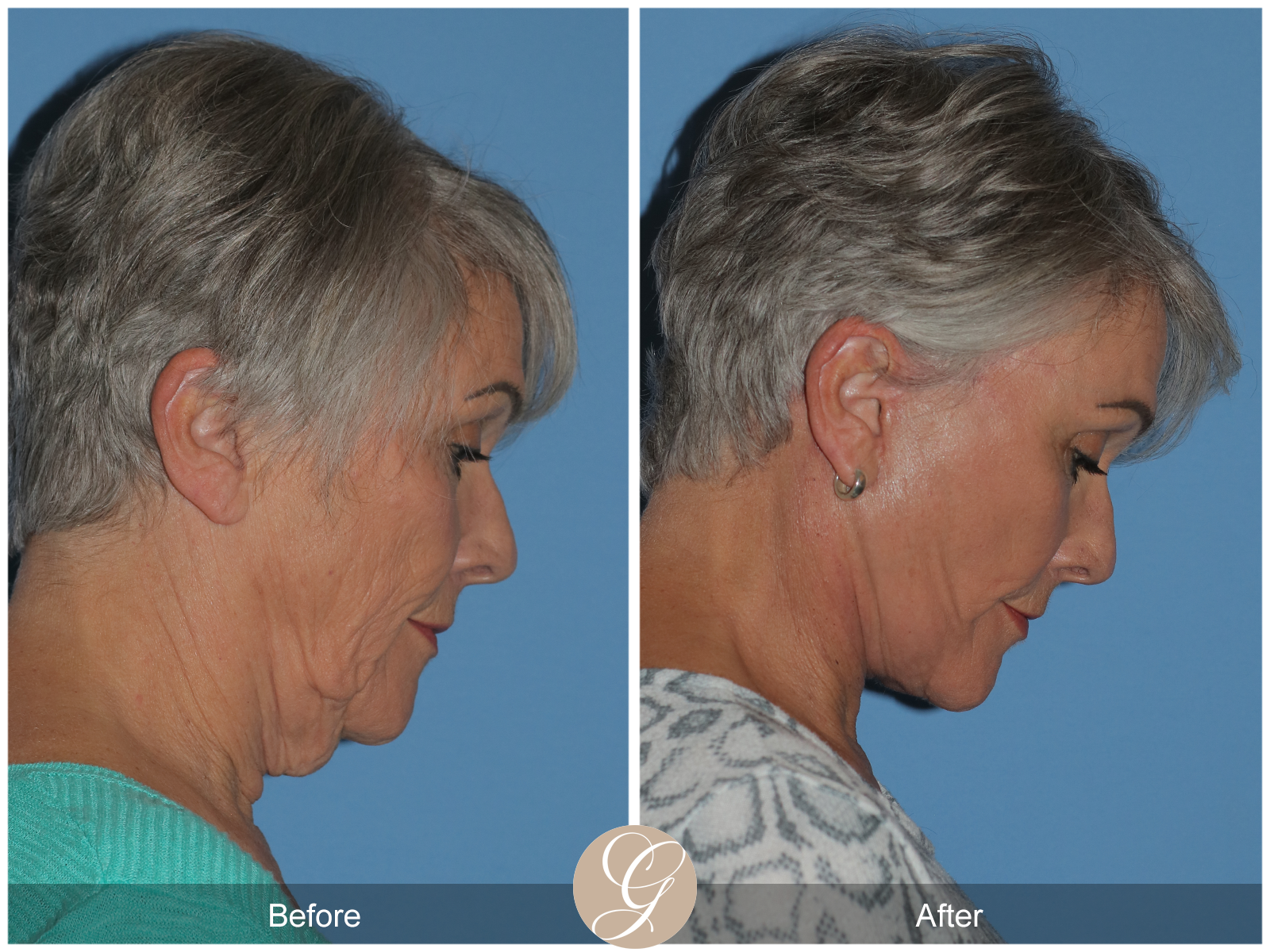 Preservation Facelift Case 8 Image