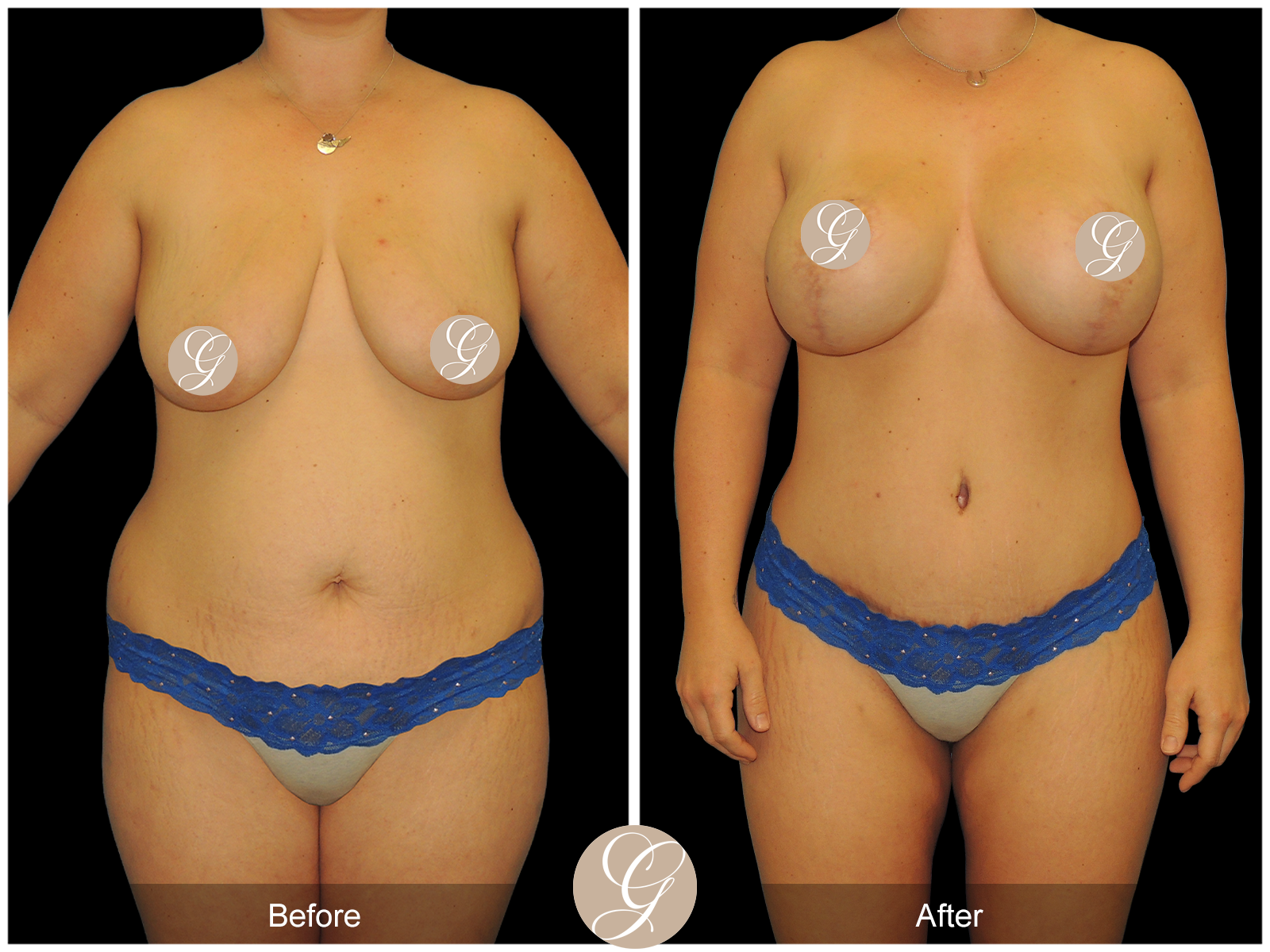 Mommy Makeover PT1 Image