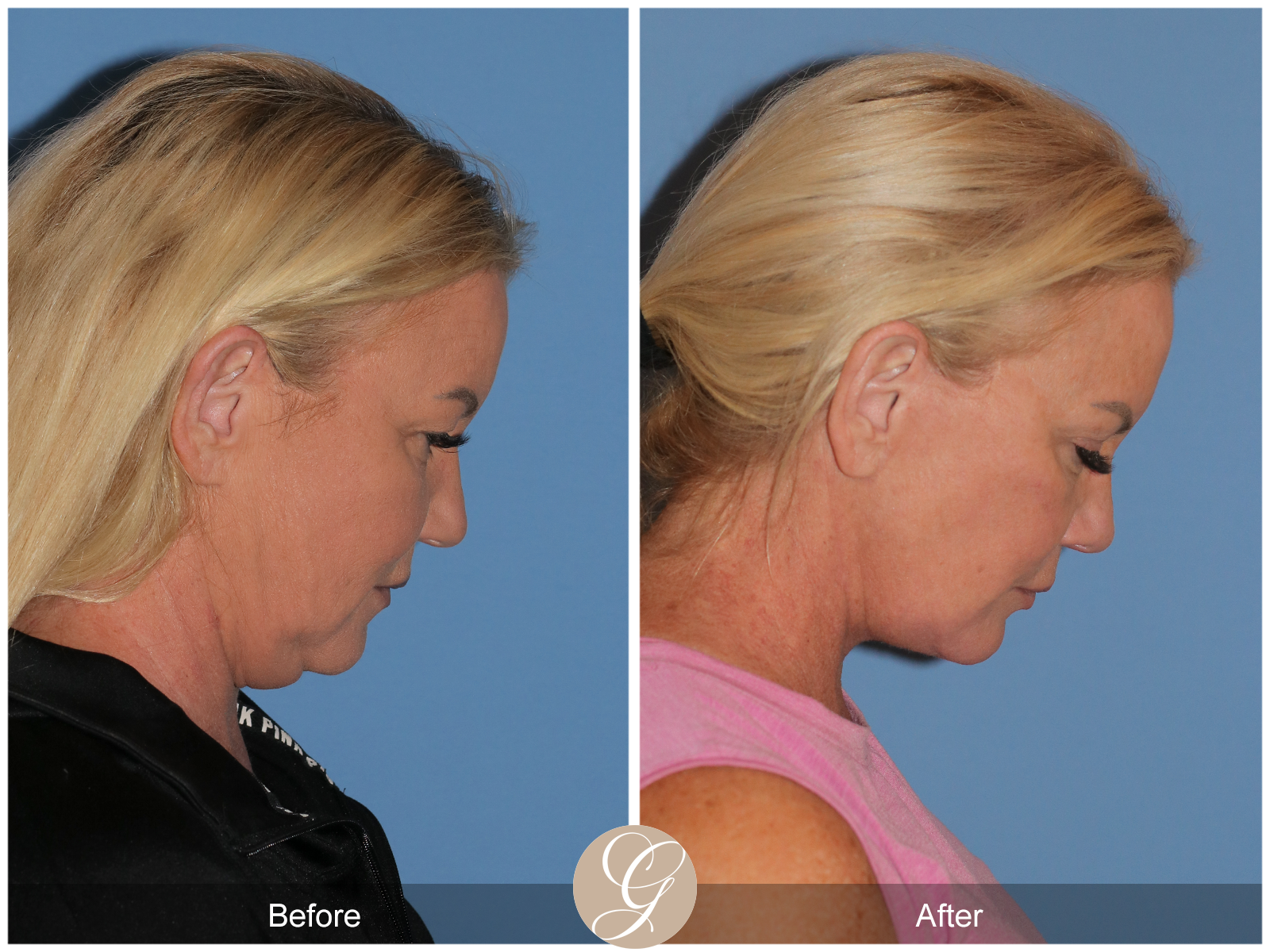 Preservation Facelift Case 9 Image