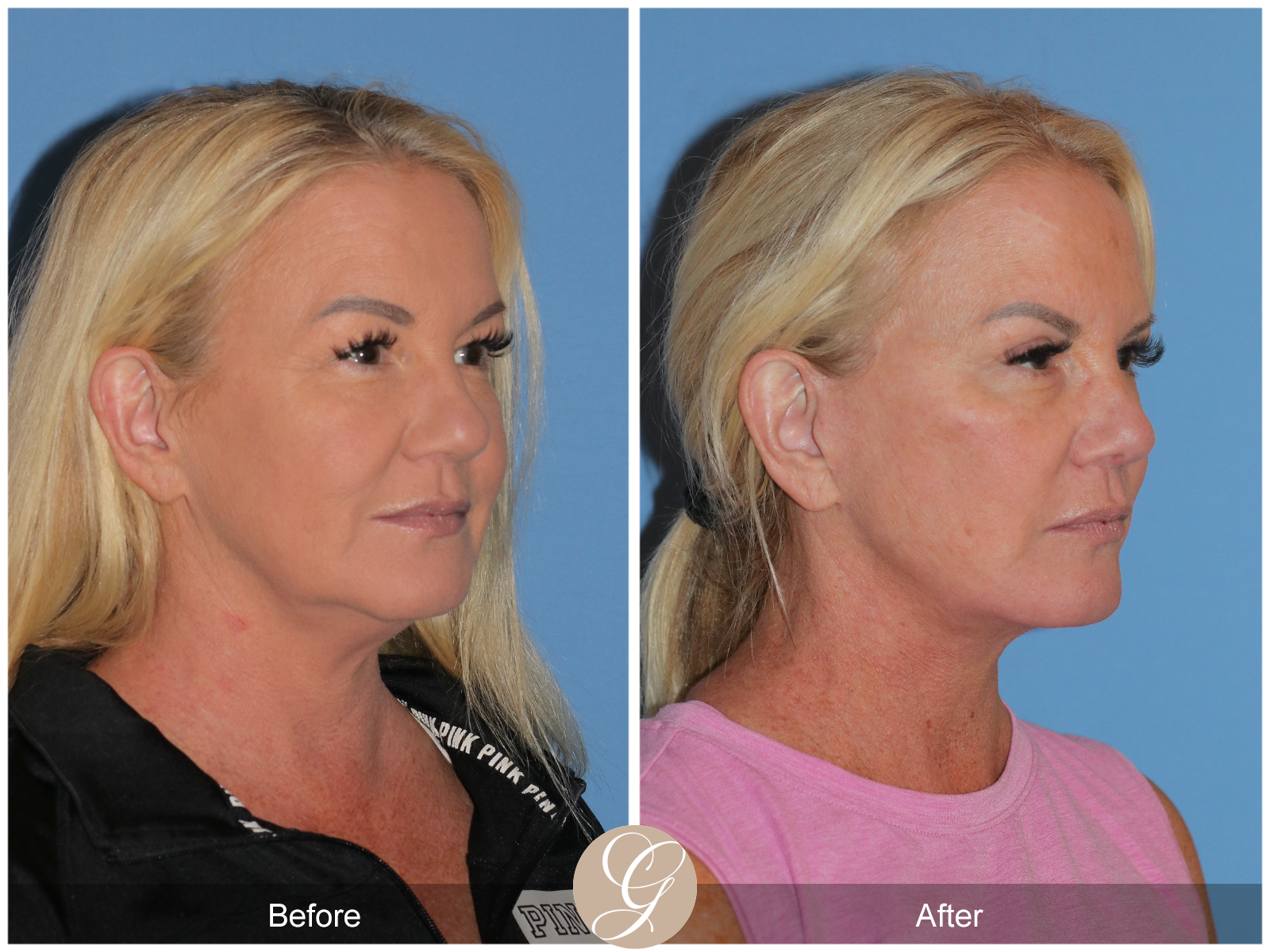 Preservation Facelift Case 9 Image