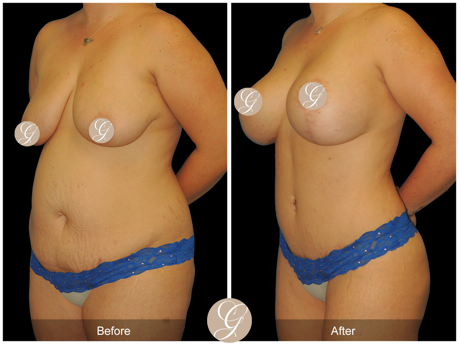 Mommy Makeover PT1 Image