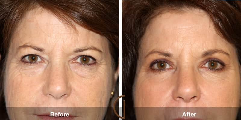 Eyelid Surgery Orange County 47 Image
