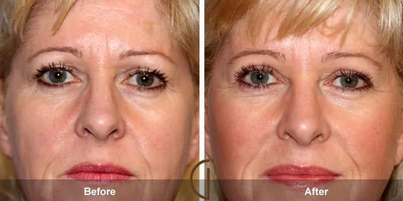Eyelid Surgery Orange County 48 Image