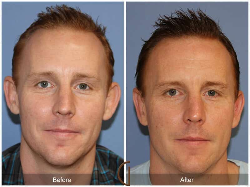 Ear Surgery Huntington Beach Image