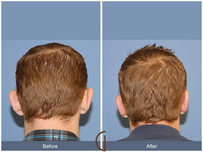 Ear Surgery Huntington Beach Image