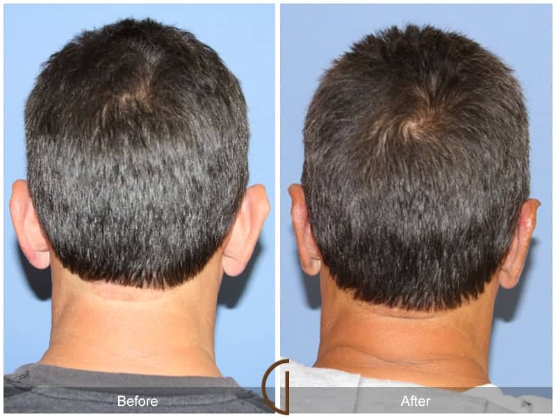 Ear Surgery Irvine Image