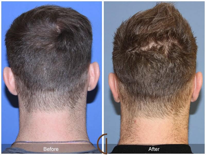 Ear Surgery Laguna Beach Image