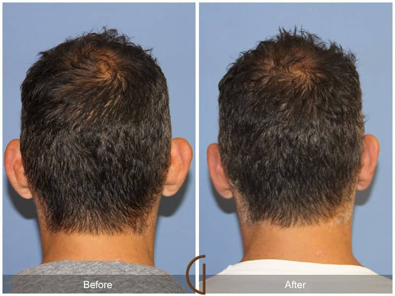 Ear Surgery Newport Beach Image