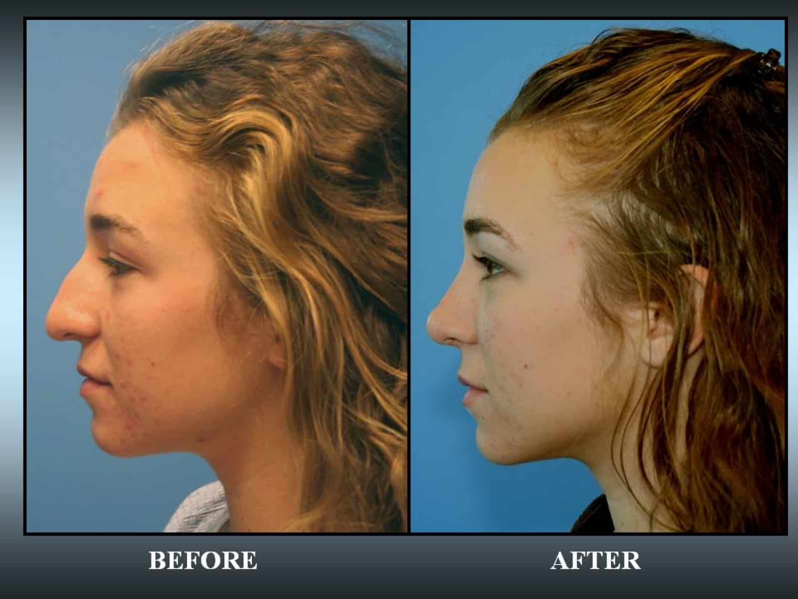 Ethnic Rhinoplasty in California Community Image
