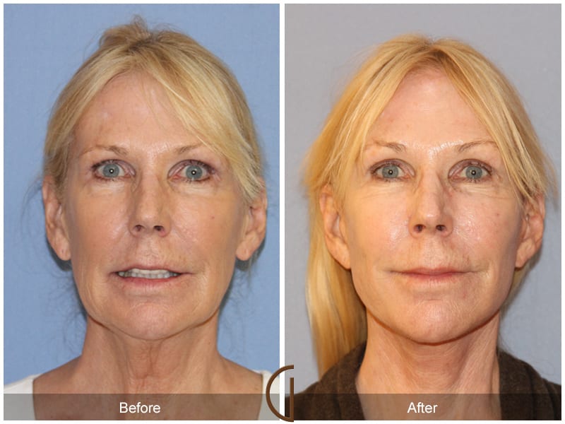 Facelift Costa Mesa Image