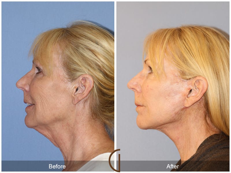 Facelift Costa Mesa Image